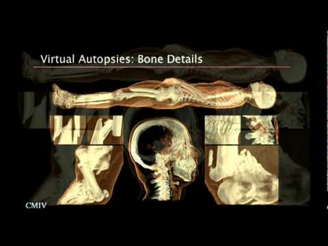 アンダース・インナーマン: 爆発的に増大する医療データの視覚化